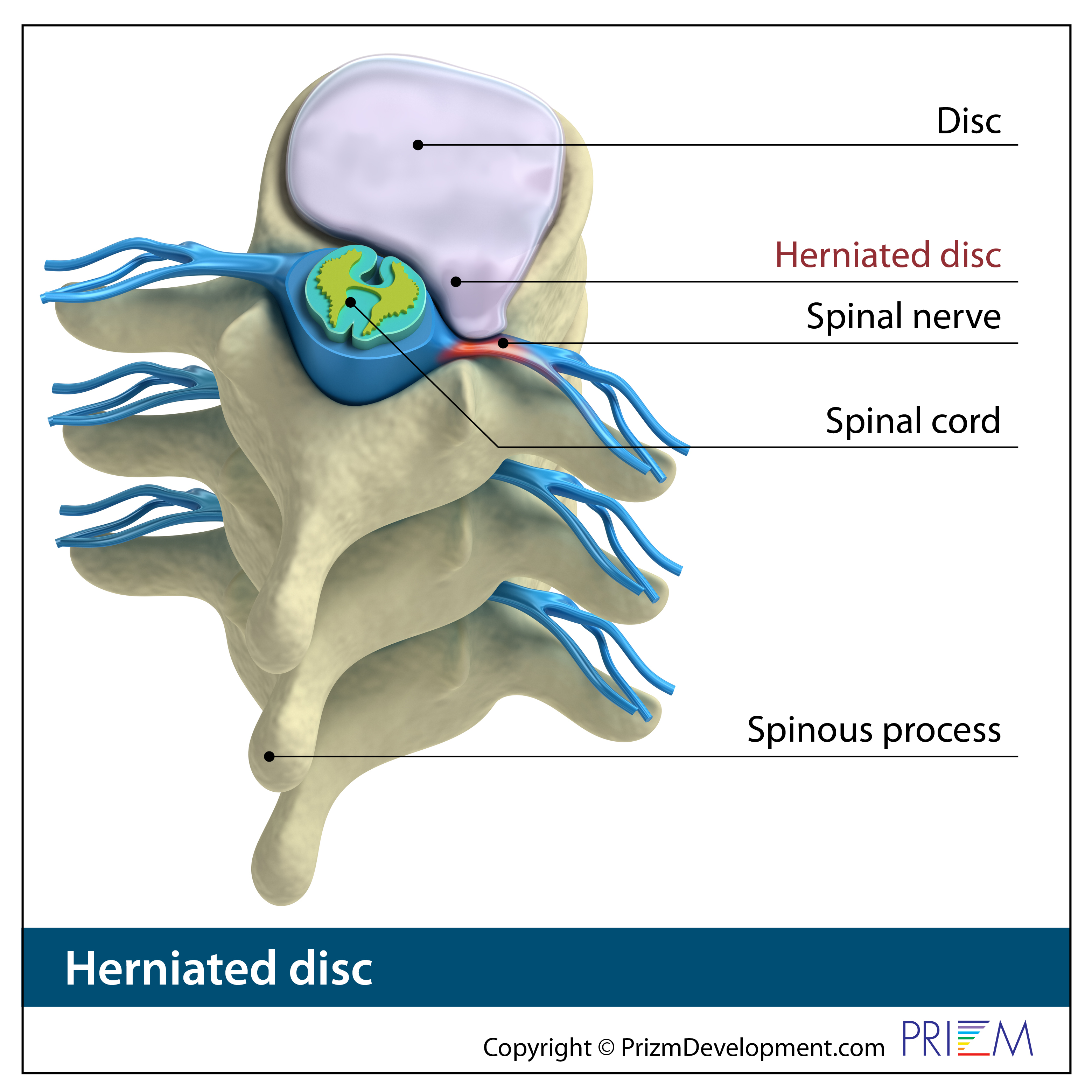 Herniated Disc Treatment in San Antonio - Texas Spine Clinic